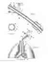 Fig. 02 - CATHETER WITH CAMERA AND ILLUMINATOR AT DISTAL END