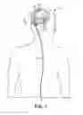 Fig. 02 - Anti-thrombogenic venous shunt method