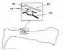 Fig. 01 - Method/device for transdermal vascular treatment