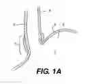 Fig. 02 - Device for fastening tissue layers