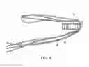 Fig. 09 - Knotless graft fixation using an implant having a pointed tip