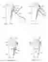 Fig. 28 - System for treating bone fractures