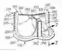 Fig. 01 - Prosthetic heart valve
