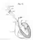 Fig. 16 - Prosthetic heart valve