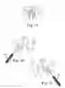 Fig. 22 - TRANSOBTURATOR SURGICAL ARTICLES AND METHODS