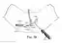 Fig. 25 - TRANSOBTURATOR SURGICAL ARTICLES AND METHODS