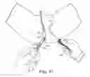 Fig. 26 - TRANSOBTURATOR SURGICAL ARTICLES AND METHODS