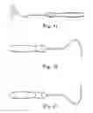 Fig. 29 - TRANSOBTURATOR SURGICAL ARTICLES AND METHODS