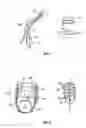 Fig. 05 - Shape-transferring cannula system and method of use