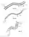 Fig. 17 - Shape-transferring cannula system and method of use