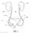 Fig. 02 - Expandable transluminal sheath