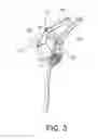 Fig. 04 - Spreading retractor