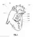 Fig. 02 - METHODS AND DEVICES FOR TREATING ATRIAL FIBRILLATION