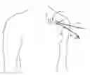 Fig. 01 - Systems and methods for gaining access around an implanted medical device