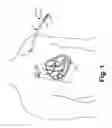 Fig. 02 - Systems and methods for gaining access around an implanted medical device