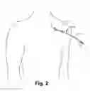 Fig. 03 - Systems and methods for gaining access around an implanted medical device