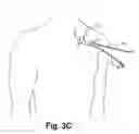 Fig. 05 - Systems and methods for gaining access around an implanted medical device