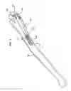 Fig. 02 - Fracture Fixation Device, Tools and Methods