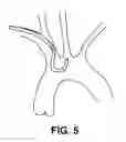 Fig. 09 - Intravascular blood filters and methods of use