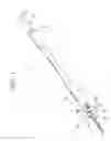 Fig. 02 - Instruments and methods for manipulating vertebra