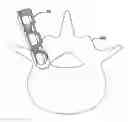 Fig. 01 - ARTICULATING INTERBODY SPACER, VERTEBRAL BODY REPLACEMENT