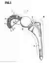 Fig. 02 - Hip joint socket