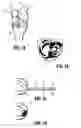 Fig. 02 - Reactive Surgical Implants