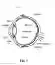 Fig. 02 - Characterization and correction of macular distortion