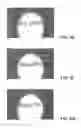 Fig. 12 - Characterization and correction of macular distortion