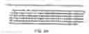 Fig. 08 - CARDIAC ARRHYTHMIA TREATMENT  METHODS AND BIOLOGICAL PACEMAKER