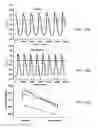 Fig. 22 - CARDIAC ARRHYTHMIA TREATMENT  METHODS AND BIOLOGICAL PACEMAKER