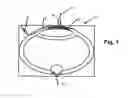 Fig. 02 - Method of lysing a thrombus