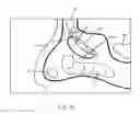 Fig. 04 - Guide catheter and method of use