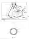 Fig. 07 - Guide catheter and method of use