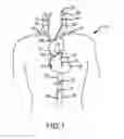 Fig. 02 - Augmented delivery catheter and method