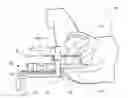 Fig. 01 - Method of percutaneous localized or focal treatment of prostate lesions using radio frequency