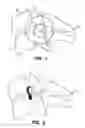 Fig. 02 - Apparatus for sizing a facet joint
