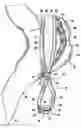 Fig. 01 - Surgical clip and surgical method for treating an aneurysm