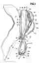 Fig. 02 - Surgical clip and surgical method for treating an aneurysm