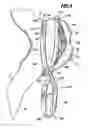 Fig. 06 - Surgical clip and surgical method for treating an aneurysm