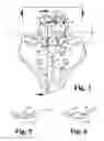 Fig. 04 - Anterior lumbar plate and method