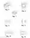 Fig. 04 - Method for stabilizing a motion segment of the spine of a patient