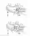 Fig. 09 - Valve prosthetic fixation techniques using sandwiching