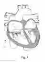 Fig. 02 - Percutaneous Mitral Annular Stitch to Decrease Mitral Regurgitation