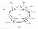Fig. 09 - Percutaneous Mitral Annular Stitch to Decrease Mitral Regurgitation