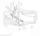 Fig. 03 - Method and Apparatus for Fixing a Graft in a Bone Tunnel