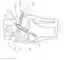 Fig. 04 - Method and Apparatus for Fixing a Graft in a Bone Tunnel