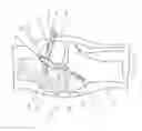 Fig. 05 - Method and Apparatus for Fixing a Graft in a Bone Tunnel