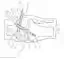 Fig. 06 - Method and Apparatus for Fixing a Graft in a Bone Tunnel