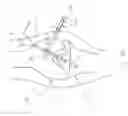 Fig. 22 - Method and Apparatus for Fixing a Graft in a Bone Tunnel